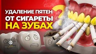  (subtitled) How to Clean Cigarette Stains on Teeth? - Lema Dental Clinic