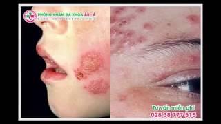 Bệnh da liễu là gì  Nguyên nhân và cách chữa bệnh hiệu quả