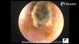 Treatment of fungal otitis externa by ear endoscope for 12 minutes 耳内镜处理真菌性外耳道炎，12分钟