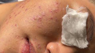 Blackheads & Whiteheads Removal New 2024 | Acne Treatment With  Bo Nguyễn Spa 029