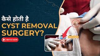 Eyelid cyst removal made easy by Dr. Jangid—watch now | SkiQure