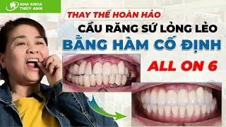 THAY THẾ CẦU RĂNG SỨ LỎNG LẺO BẰNG HÀM CỐ ĐỊNH ALL ON 6