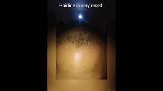 Minoxidil result | finasteride result | 6 month result #hairloss  #minoxidil #hairgrowth #hairloss