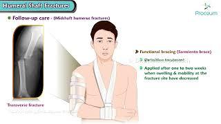 Humeral Shaft Fractures: Orthopedics Lectures