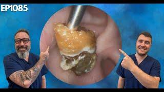 The Most Satisfying Ear Wax Removal Videos! - EP1085