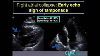 Pericardial Tamponade Echo