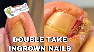 Double Ingrown Nail Surgery Dr. Cruz Healthy Feet Podiatry Tampa | Brooksville | Wesley Chapel