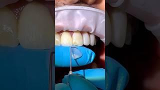 No-Prep Ceramic Veneer Repair: Part I #veneers #repairs #biomimeticdentistry