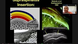 Dr. Jeimylo de Castro talks about COMMON MSK Ultrasound Shoulder Pathology