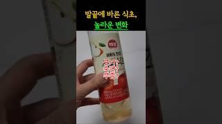 발끝에 식초바르면?다리피로,붓기,수면문제까지, 밤마다 발을 닦는 습관, 식초효능