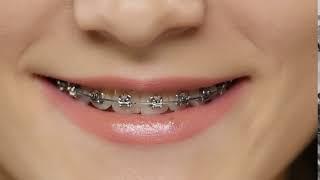 Benefits of Metal Braces | Bellaviso Medical Center