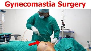 Gynecomastia Surgery in delhi | Gynecomastia Surgery result | Dezire Clinic