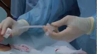 Initial Placement of the EndoVive™ Safety Percutaneous Endoscopic Gastrostomy (PEG) Tube