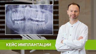 Как проходит операция по удалению зуба и одномоментной установки импланта — Стоматология Рица