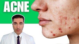 ACNE : Causes, Symptoms, Natural Treatment | MarioLab