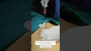 Penis fat grafting surgery  | Dr. Ashutosh Shah | Elegance Clinic - Surat