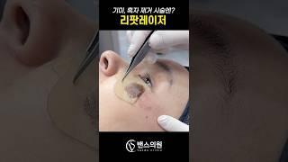 기미, 흑자 제거 시술엔? #리팟레이저