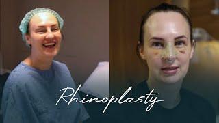 Rachel's Rhinoplasty Journey | MedAway