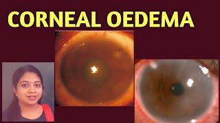 Corneal Oedema|| Epithelial Oedema|| Stromal| Striate keratopathy|Signs| Treatment of Corneal oedema