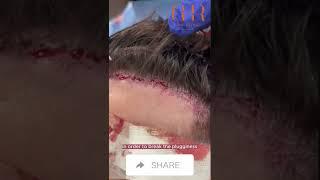 Pluggy Hair Transplant Repair #shorts