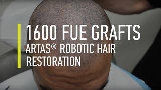 1600 FUE Grafts ARTAS® Robotic Hair Restoration in Hair By Dr. Max, Restoration Center