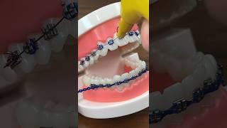 HOW THEY FIX BRACE #viral #youtubeshorts #youtubeviral #dentistry #dentist #braces