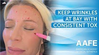 Keep Wrinkles At Bay With Consistent Tox