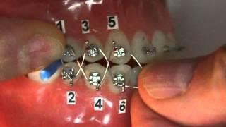 Orthodontic Jaw Wiring in the Dental Professional Office