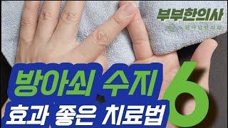 124.방아쇠 수지 간단하고 효과 좋은 자가 치료 방법(방아쇠 손가락, Trigger Finger exercise) ㅣ한의학 박사, 침구과 전문의, 김경태 원장 | ft 부부한의사