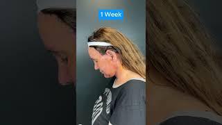 HUGE FACELIFT TRANSFORMATION (2 Week Update)