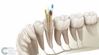 Endodontics | Root canal treatment | City Dental Clinic Bratislava