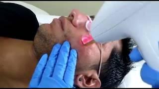 Acne Scar Removal in Delhi at Delhi Laser Clinic, Dwarka