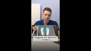 Ходьба на носках из-за плоскостопия 