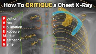 How To Critique a Chest X-Ray! [4 DIFFERENT EXAMPLES]