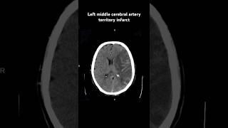Left middle cerebral artery territory infarct #reels