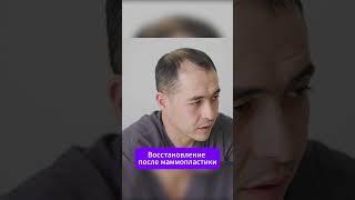 Как проходит восстановление после маммопластики #кдлолимп #лабораторияолимп