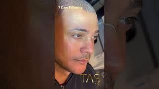 Chin Augmentation, Neck Liposuction, Rhinoplasty & Hair Transplant by Dr. TAS