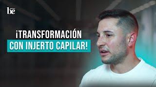 Increíble Transformación de Víctor: Testimonio Resultados de Injerto Capilar FUE Motor | Clínicas Be