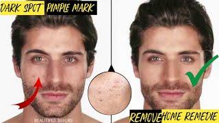 Dark spot, pimple mark, black spot remove ||homemade nuska||how to remove pimple mark ||