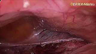 Laparoscopic Mishra's Knot demonstration by Dr R K Mishra