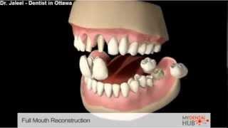 Prosthodontics - Full Mouth Reconstruction - Dentist Ottawa