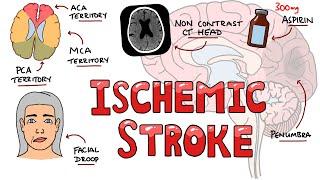 Acute Ischemic Stroke - Signs and Symptoms (Stroke Syndromes) | Causes & Mechanisms | Treatment