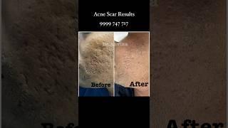 Acne Scars - Can be treated with lasers combination !!