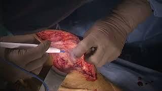 TKR IN STIFF KNEE BY "MINIMUM CUT TECHNIQUE" SURGICAL DEMOSTRATION