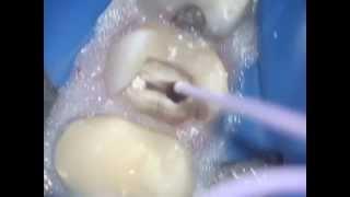 Bioceramic Obturation