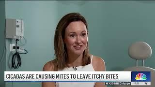 Itchy mite bites linked to cicada invasion on the rise