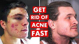 5 DO's & DON'TS To Get Rid of Acne FAST!