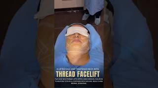 Thread Facelift: Instant Skin Lift & Youthful Glow by Dr. Adarsh Tripathi #beauty