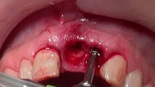 Immediate Implant Placement (Paltop)- Raptos, Osseoguard, Mucoderm and Provizionalisation