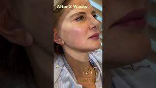 30 years back with Scarless Facelift by Dr. Suleyman TAS